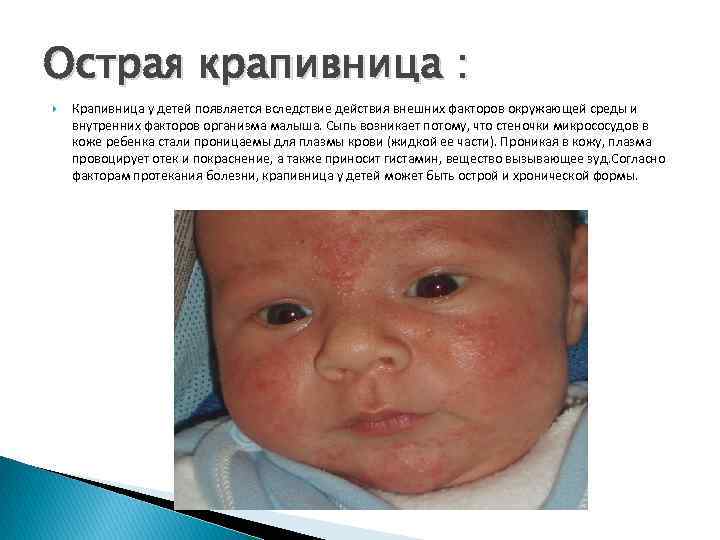 Острая крапивница : Крапивница у детей появляется вследствие действия внешних факторов окружающей среды и