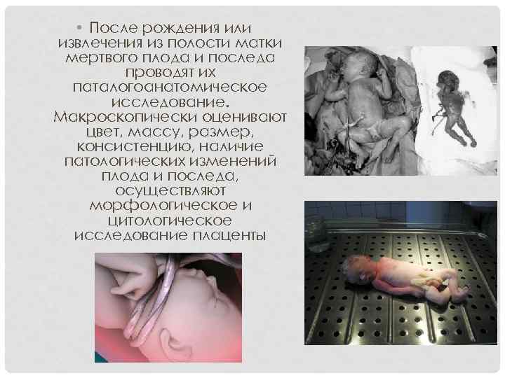  • После рождения или извлечения из полости матки мертвого плода и последа проводят