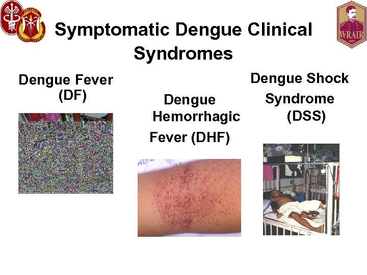 Symptomatic Dengue Clinical Syndromes Dengue Fever (DF) Dengue Shock Syndrome Dengue (DSS) Hemorrhagic Fever