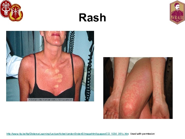 Rash http: //www. itg. be/itg/Distance. Learning/Lecture. Notes. Vanden. E/imagehtml/ppages/CD_1038_061 c. htm. Used with permission