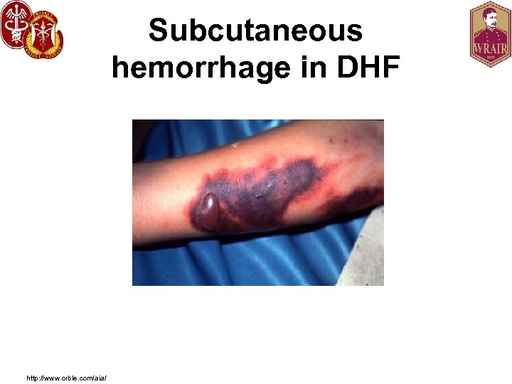 Subcutaneous hemorrhage in DHF http: //www. orble. com/aia/ 