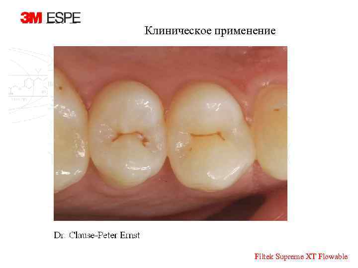 Клиническое применение Filtek Supreme XT Flowable 