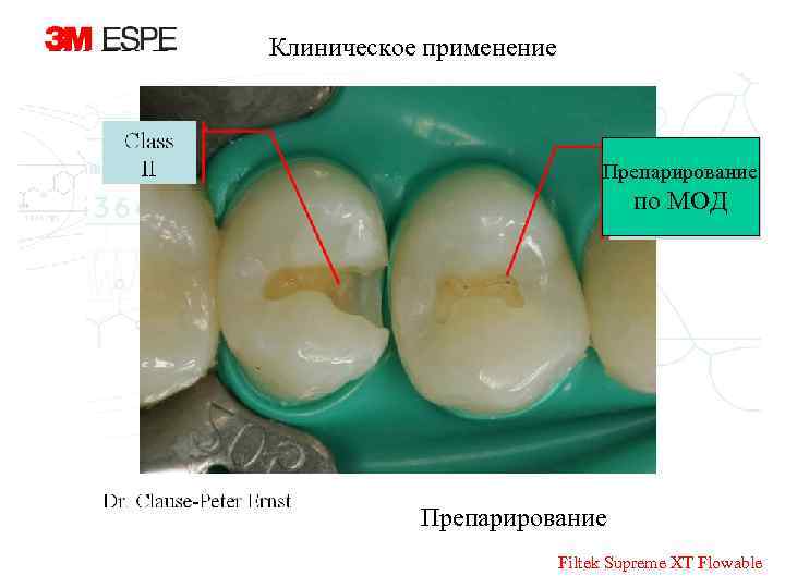 Клиническое применение Препарирование по МОД Препарирование Filtek Supreme XT Flowable 