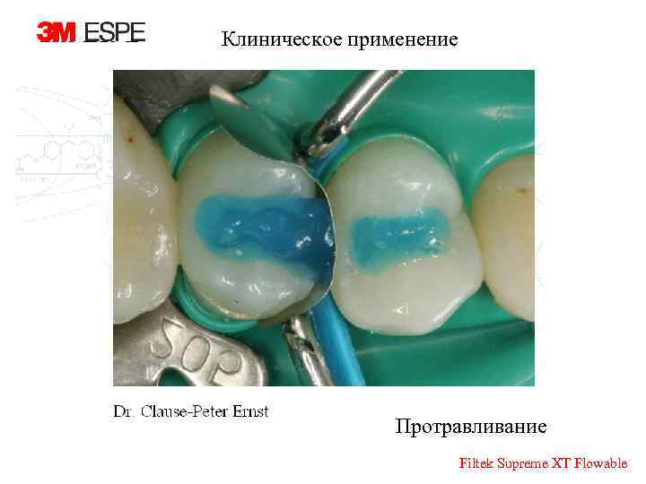 Клиническое применение Протравливание Filtek Supreme XT Flowable 