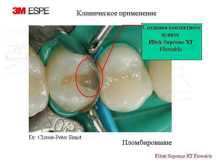 Клиническое применение Создания контактного пункта Filtek Supreme XT Flowable Пломбирование Filtek Supreme XT Flowable