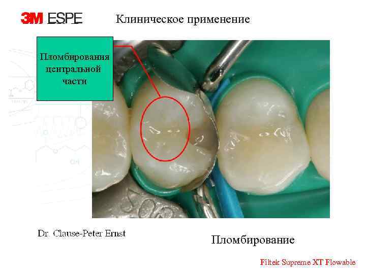 Клиническое применение Пломбирования центральной части Пломбирование Filtek Supreme XT Flowable 