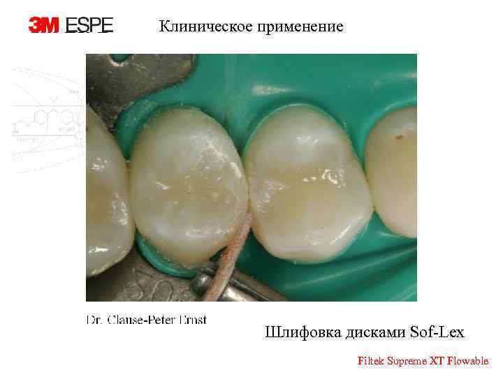 Клиническое применение Шлифовка дисками Sof-Lex Filtek Supreme XT Flowable 