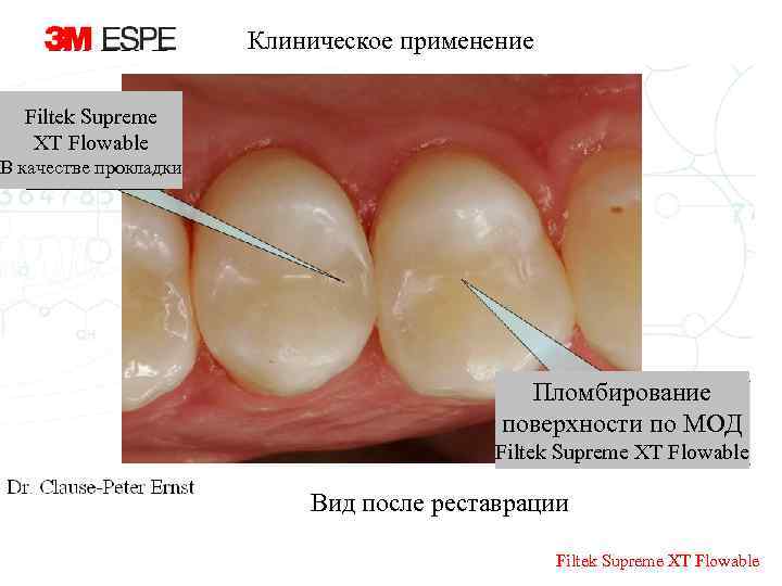 Клиническое применение Filtek Supreme XT Flowable В качестве прокладки Пломбирование поверхности по МОД Filtek