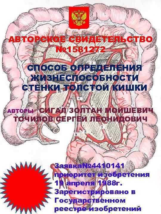 АВТОРСКОЕ СВИДЕТЕЛЬСТВО № 1581272 СПОСОБ ОПРЕДЕЛЕНИЯ ЖИЗНЕСПОСОБНОСТИ СТЕНКИ ТОЛСТОЙ КИШКИ СИГАЛ ЗОЛТАН МОЙШЕВИЧ ТОЧИЛОВ