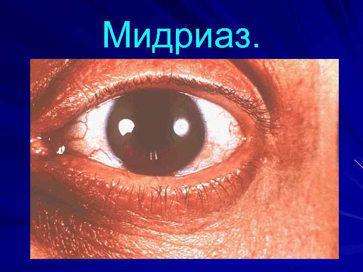 Мидриаз. 