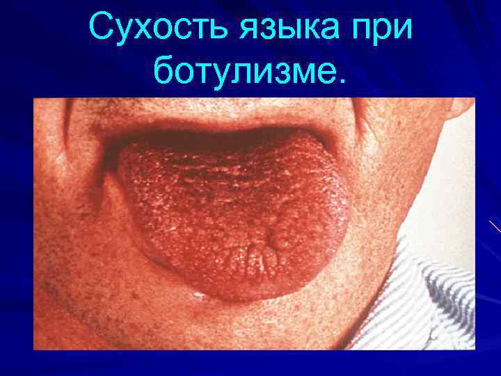 Сухость языка при ботулизме. 