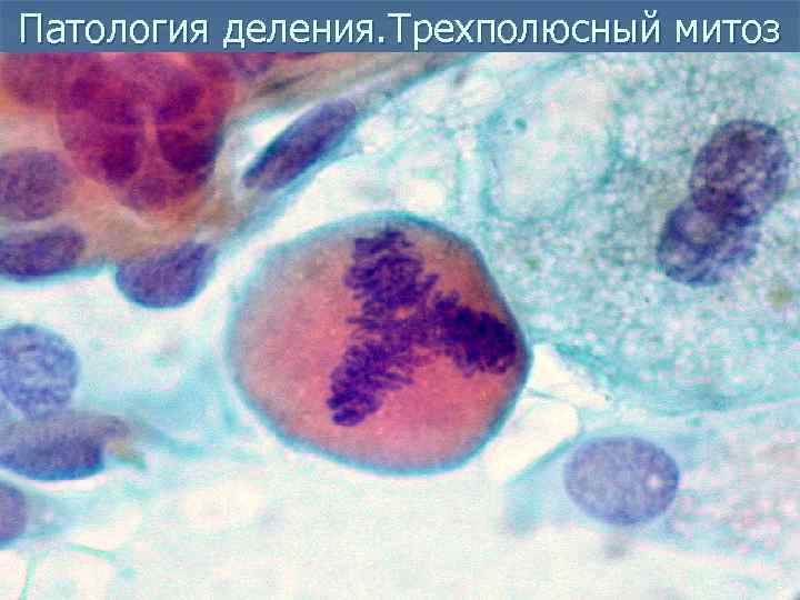 Патология деления. Трехполюсный митоз 