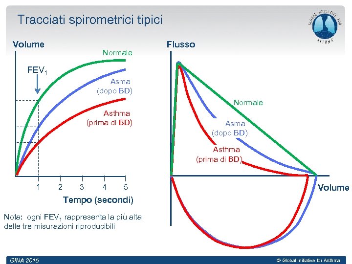 Tracciati spirometrici tipici Volume Normale Flusso FEV 1 Asma (dopo BD) Normale Asthma (prima