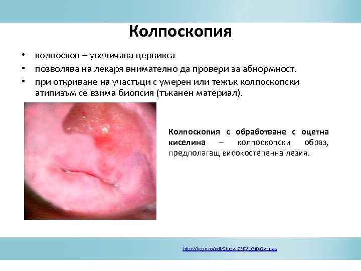 Колпоскопия • колпоскоп – увеличава цервикса • позволява на лекаря внимателно да провери за