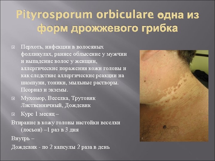 Pityrosporum orbiculare одна из – форм дрожжевого грибка Перхоть, инфекции в волосяных фолликулах, раннее
