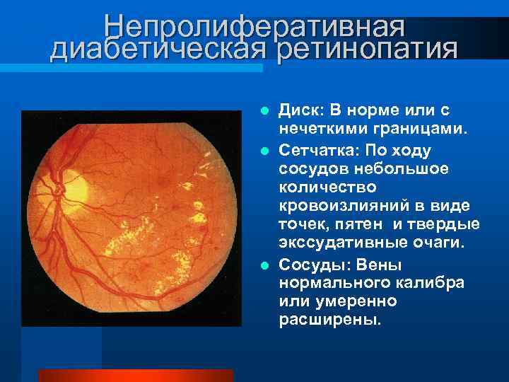 Диабетическая ретинопатия презентация офтальмология