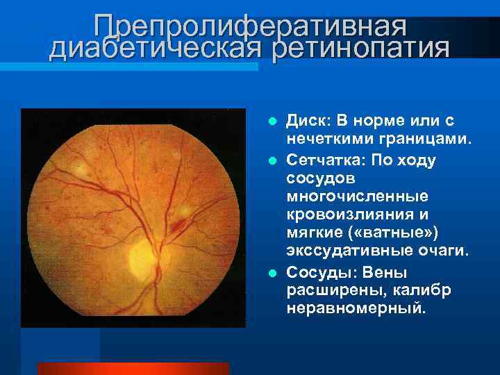 Изменение глазного дна при сахарном диабете презентация