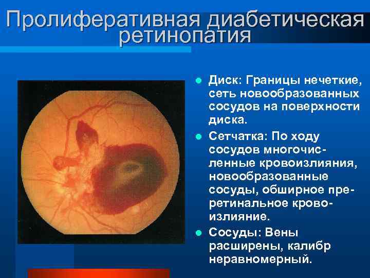 Пролиферативная диабетическая ретинопатия Диск: Границы нечеткие, сеть новообразованных сосудов на поверхности диска. l Сетчатка:
