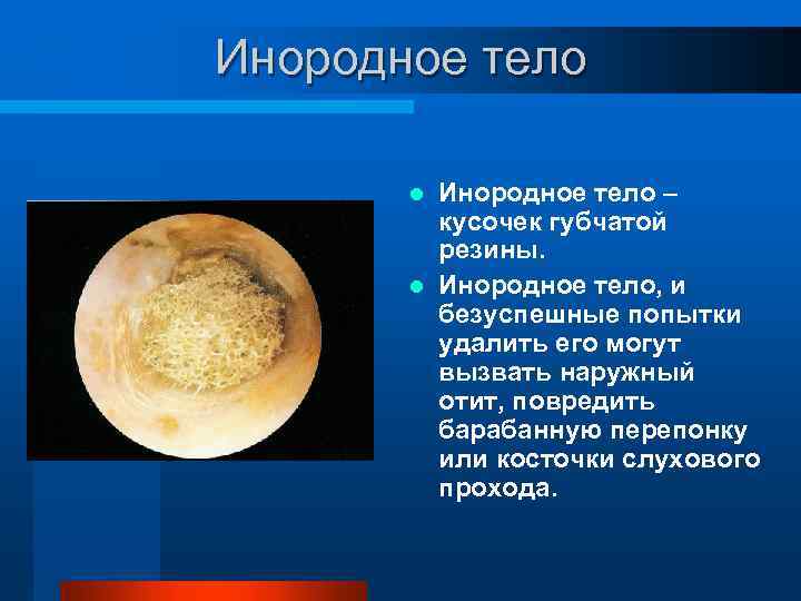 Инородное тело – кусочек губчатой резины. l Инородное тело, и безуспешные попытки удалить его