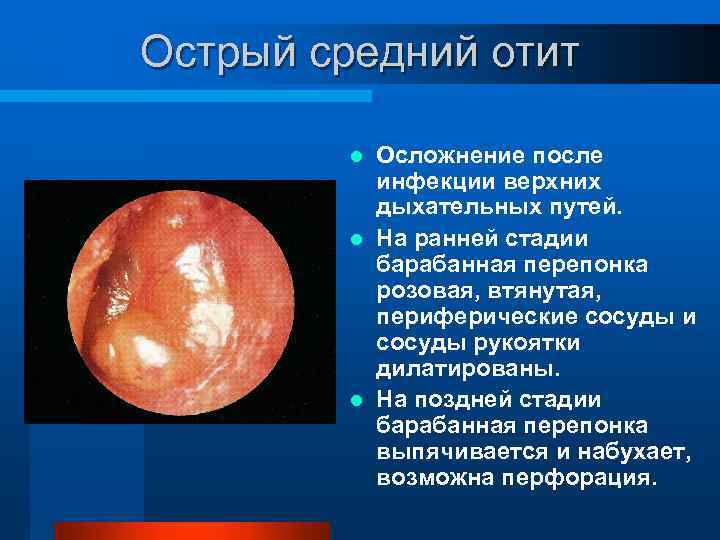 Острый средний отит Осложнение после инфекции верхних дыхательных путей. l На ранней стадии барабанная