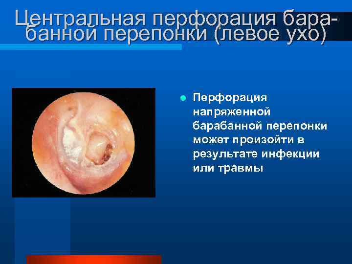 Центральная перфорация барабанной перепонки (левое ухо) l Перфорация напряженной барабанной перепонки может произойти в