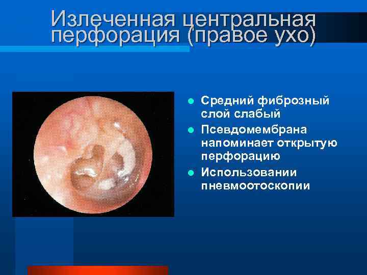 Излеченная центральная перфорация (правое ухо) Средний фиброзный слой слабый l Псевдомембрана напоминает открытую перфорацию