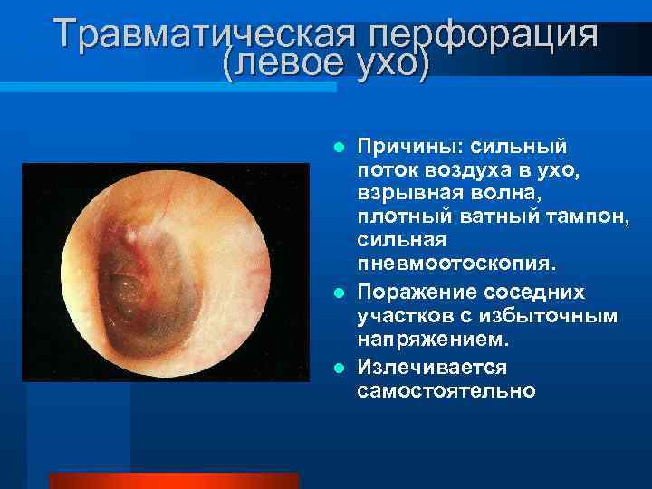 Травматическая перфорация (левое ухо) Причины: сильный поток воздуха в ухо, взрывная волна, плотный ватный