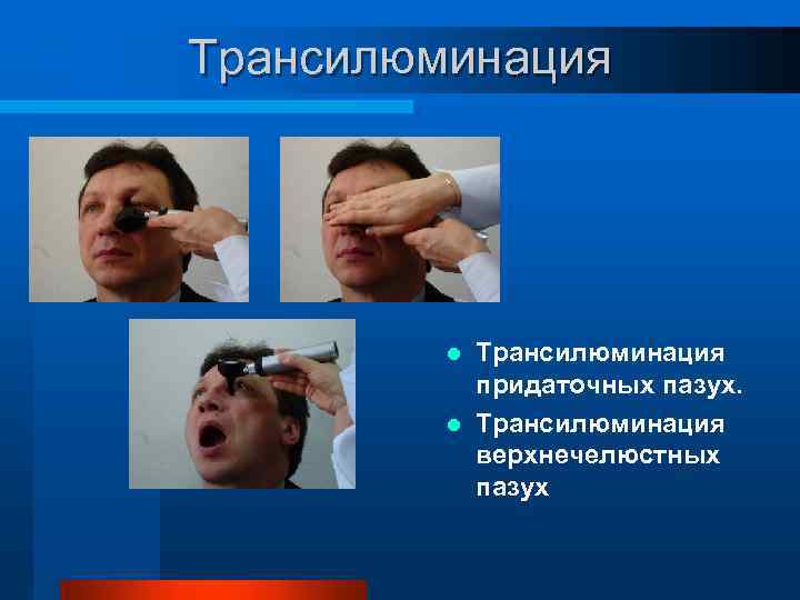 Трансилюминация придаточных пазух. l Трансилюминация верхнечелюстных пазух l 