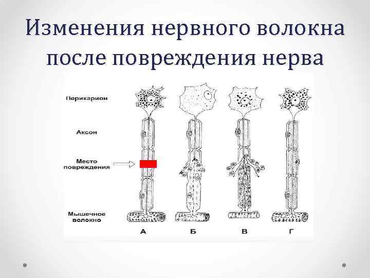 Изменения нервного волокна после повреждения нерва 