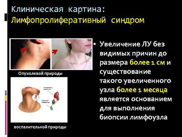 Клиническая картина: Лимфопролиферативный синдром Опухолевой природы воспалительной природы Увеличение ЛУ без видимых причин до