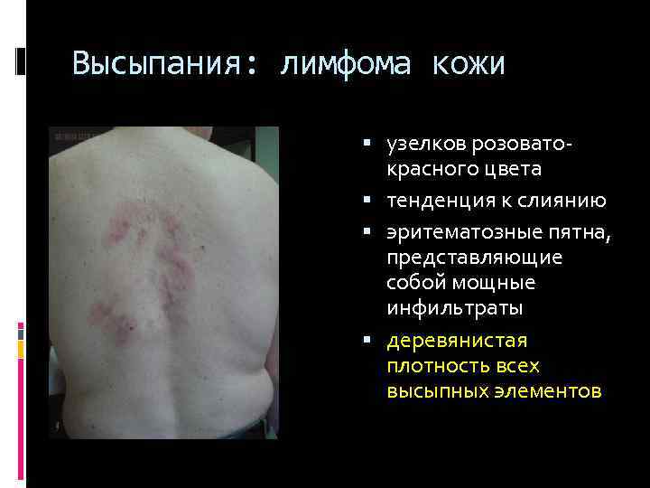 Высыпания: лимфома кожи узелков розовато красного цвета тенденция к слиянию эритематозные пятна, представляющие собой