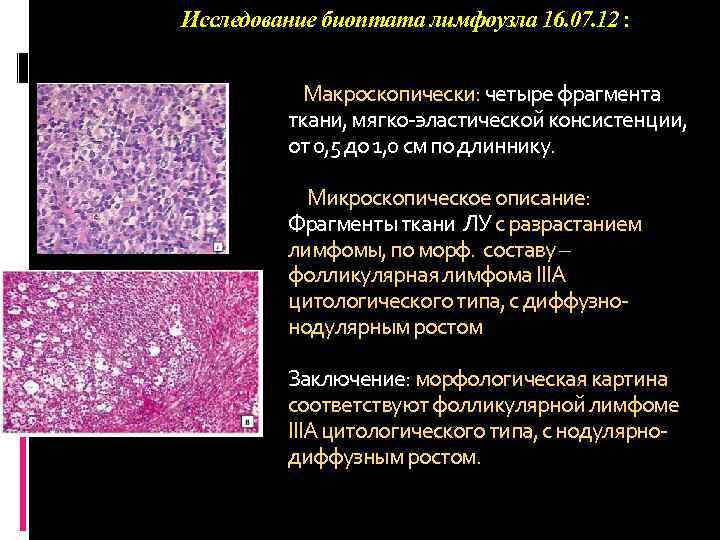 Исследование биоптата лимфоузла 16. 07. 12 : Макроскопически: четыре фрагмента ткани, мягко эластической консистенции,