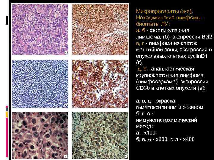 Микропрепараты (а-е). Неходжкинские лимфомы : биоптаты ЛУ: а, б - фолликулярная лимфома, (б); экспрессия