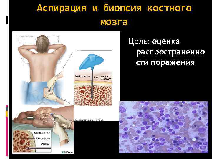 Аспирация и биопсия костного мозга Цель: оценка распространенно сти поражения 