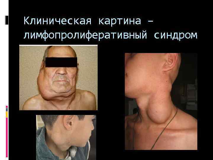 Клиническая картина – лимфопролиферативный синдром 