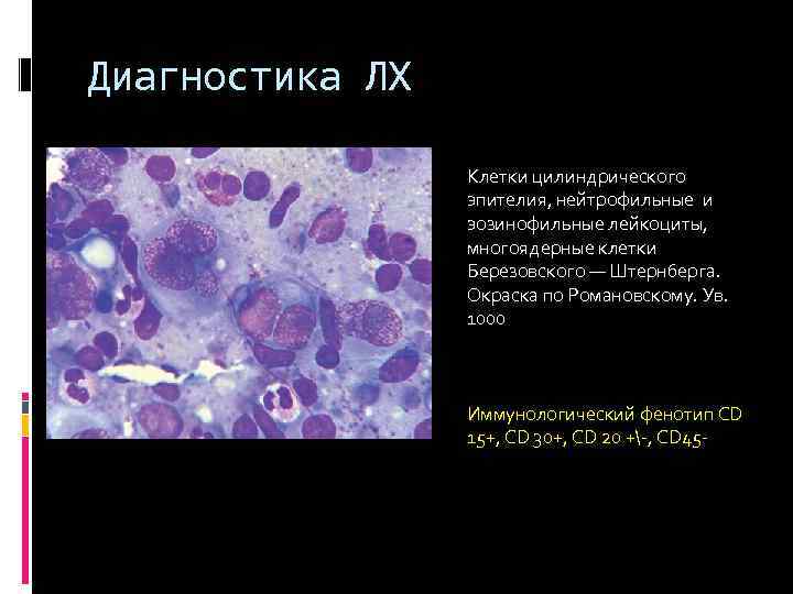 Диагностика ЛХ Клетки цилиндрического эпителия, нейтрофильные и эозинофильные лейкоциты, многоядерные клетки Березовского — Штернберга.