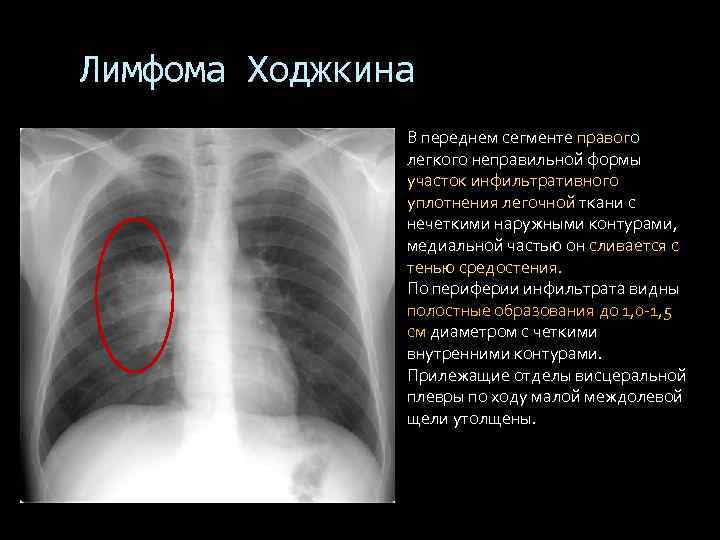 Лимфома Ходжкина В переднем сегменте правого легкого неправильной формы участок инфильтративного уплотнения легочной ткани