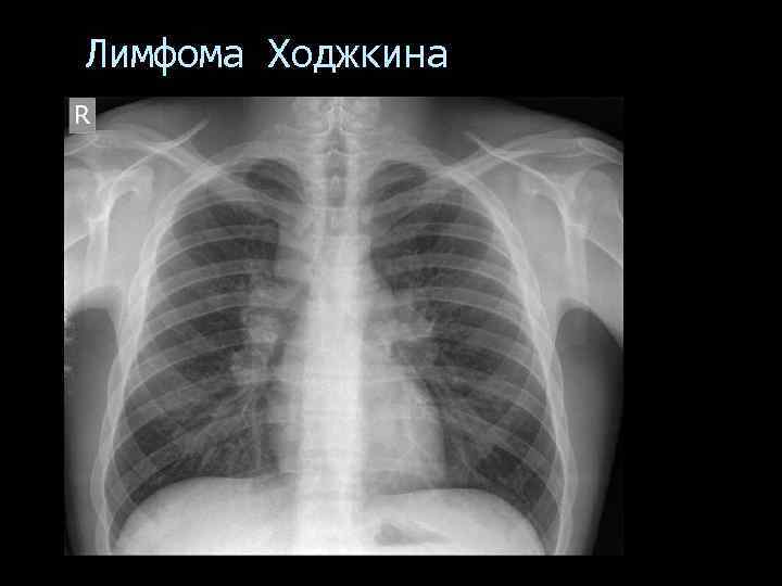 Лимфома Ходжкина 