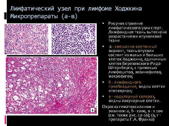 Лимфопролиферативные заболевания презентация