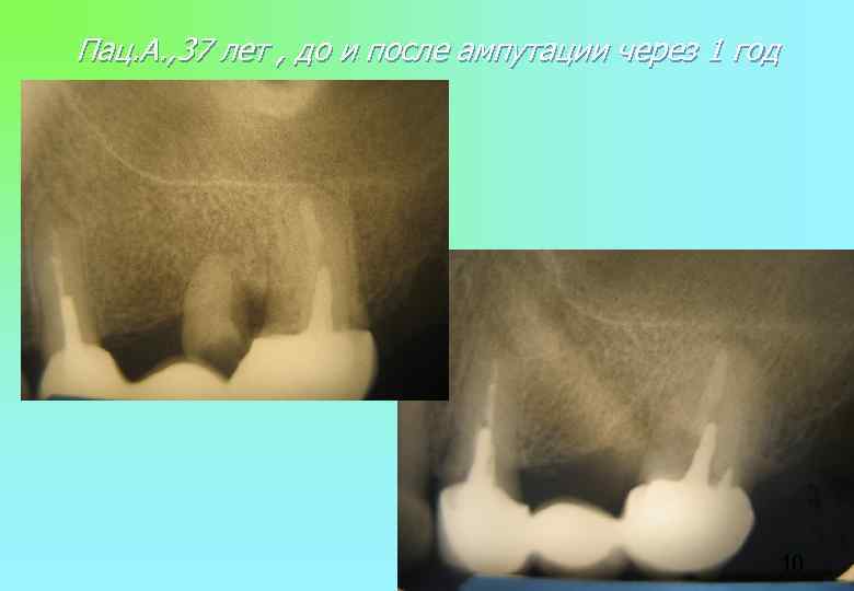 Пац. А. , 37 лет , до и после ампутации через 1 год 10