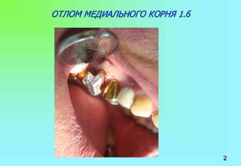 ОТЛОМ МЕДИАЛЬНОГО КОРНЯ 1. 6 2 