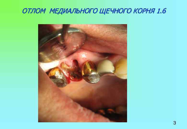 ОТЛОМ МЕДИАЛЬНОГО ЩЕЧНОГО КОРНЯ 1. 6 3 
