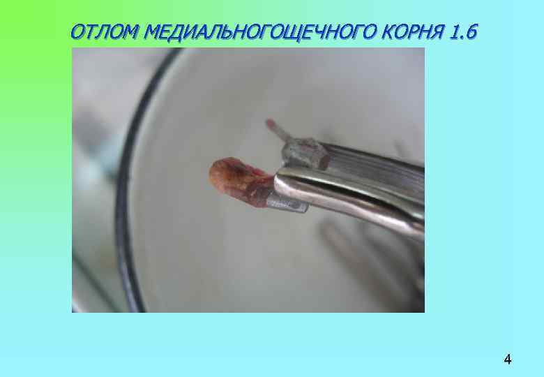 ОТЛОМ МЕДИАЛЬНОГОЩЕЧНОГО КОРНЯ 1. 6 4 