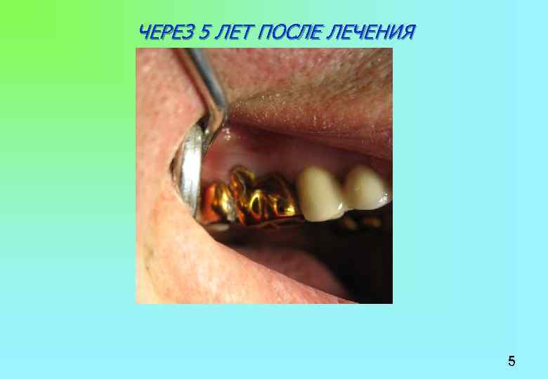 ЧЕРЕЗ 5 ЛЕТ ПОСЛЕ ЛЕЧЕНИЯ 5 