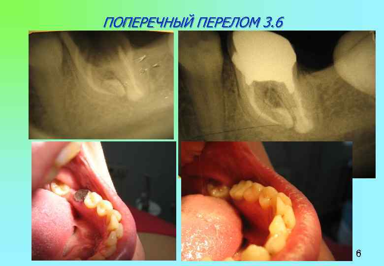 ПОПЕРЕЧНЫЙ ПЕРЕЛОМ 3. 6 6 