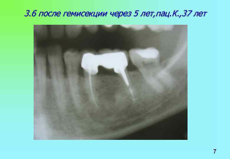 3. 6 после гемисекции через 5 лет, пац. К. , 37 лет 7 