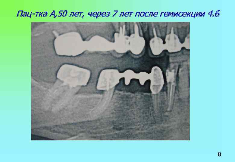 Пац-тка А, 50 лет, через 7 лет после гемисекции 4. 6 8 