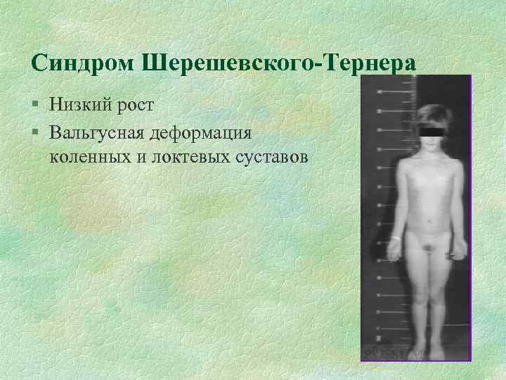 Синдром Шерешевского-Тернера Низкий рост Вальгусная деформация коленных и локтевых суставов 