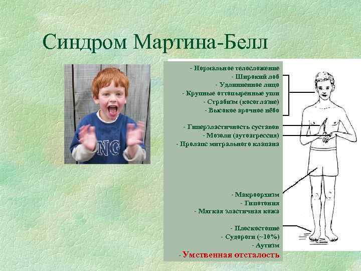 Синдром мартина белла фото детей