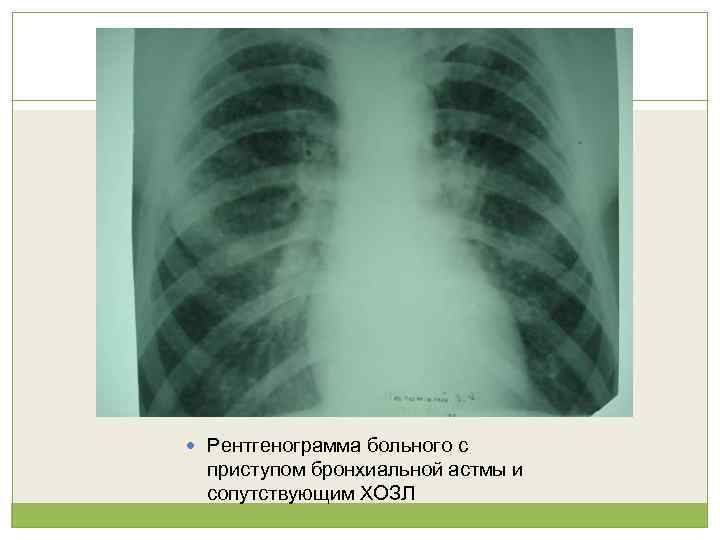  Рентгенограмма больного с приступом бронхиальной астмы и сопутствующим ХОЗЛ 